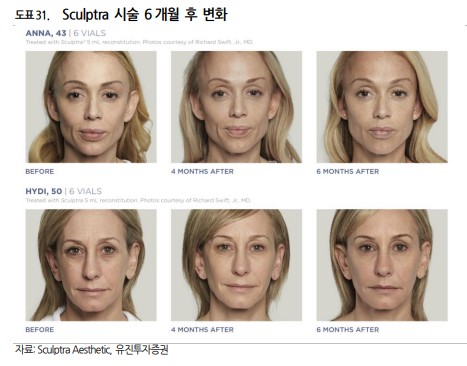 Sculptra 시술 6개월 후 변화